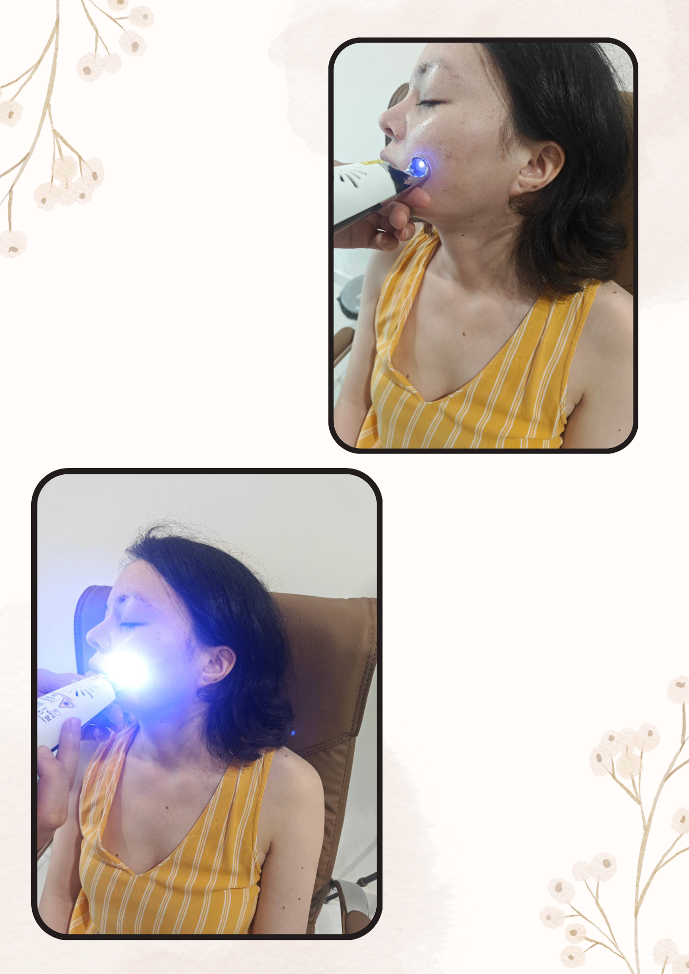 Xoá hột ruồi
